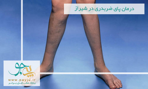 درمان پای ضربدری در شیراز