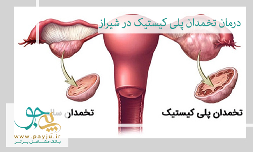 درمان تخمدان پلی کیستیک در شیراز