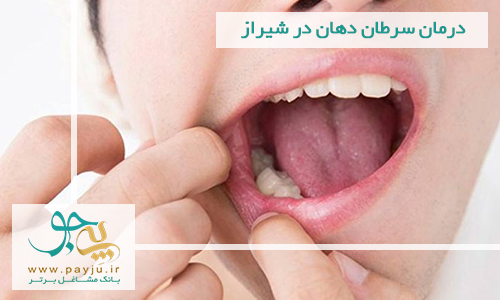  درمان سرطان دهان در شیراز
