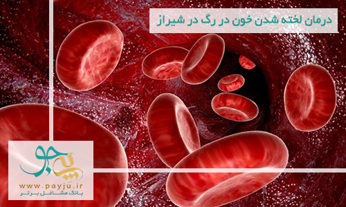 درمان لخته شدن خون در رگ در شیراز