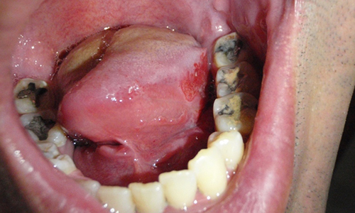 مازندران ، طرح غربالگري سرطان دهان را اجرايي كرد