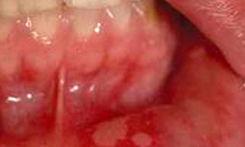 هشدار يك متخصص آسيب شناسي دهان: زخم‌هاي سرطان دهان را با آفت اشتباه نگيريد تعدد بروز آفت نشانه ابتلا به ايدز نيست
