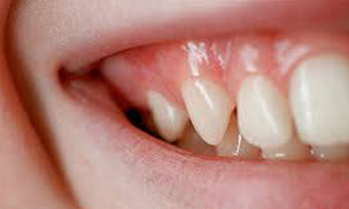كمبود ويتامين A وC و E در بروز سرطان دهان نقش دارد
