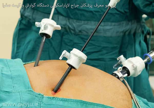لاپاراسکوپی دستگاه گوارش و کیسه صفرا در شیراز