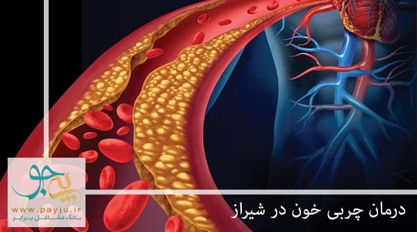 درمان چربی خون در شیراز
