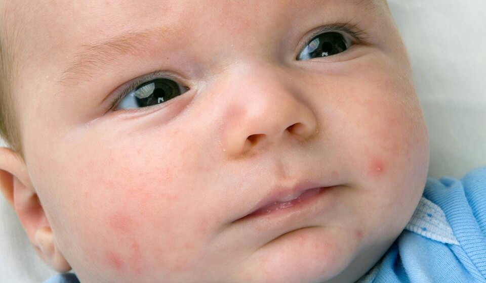 جوش صورت نوزاد : ۹ درمان خانگی جوش نوزادان
