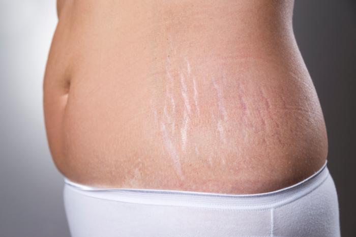 ترک پوستی : ۲۰ درمان خانگی ساده برای رفع ترک های پوستی