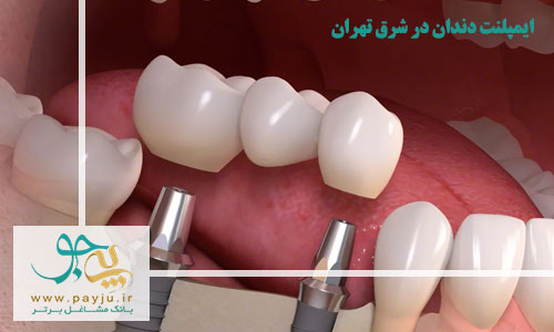 ایمپلنت دندان در شرق