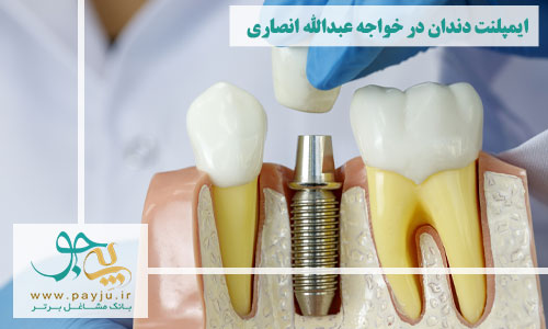ایمپلنت دندان در خواجه عبدالله انصاری