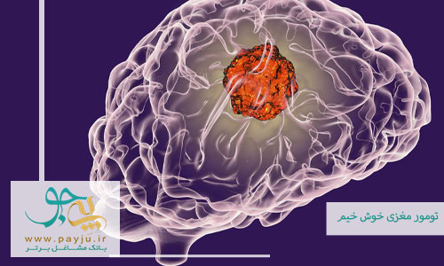 تومورهای مغزی خوش خیم از علائم تا درمان