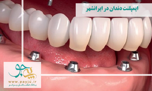 ایمپلنت دندان در ایرانشهر