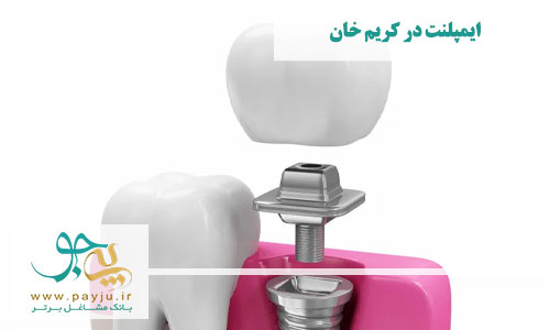 ایمپلنت دندان در کریم خان