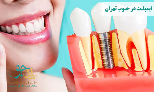 ایمپلنت دندان در جنوب تهران
