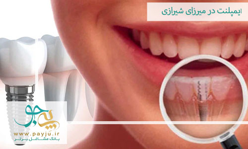 ایمپلنت دندان در میرزای شیرازی