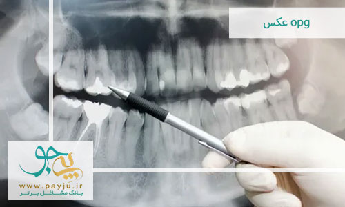 عکس OPG دندان چیست و چه کاربردی دارد؟