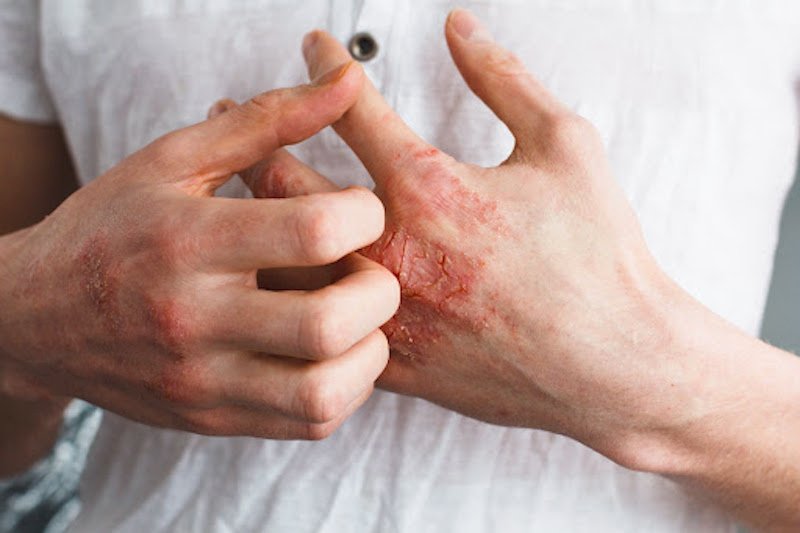 بلغور جو دوسر کلوئیدی: راه طبیعی برای درمان اگزما و تسکین پوست