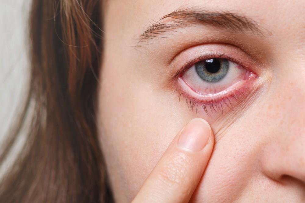 چگونه از آنفولانزای چشم محافظت کنیم