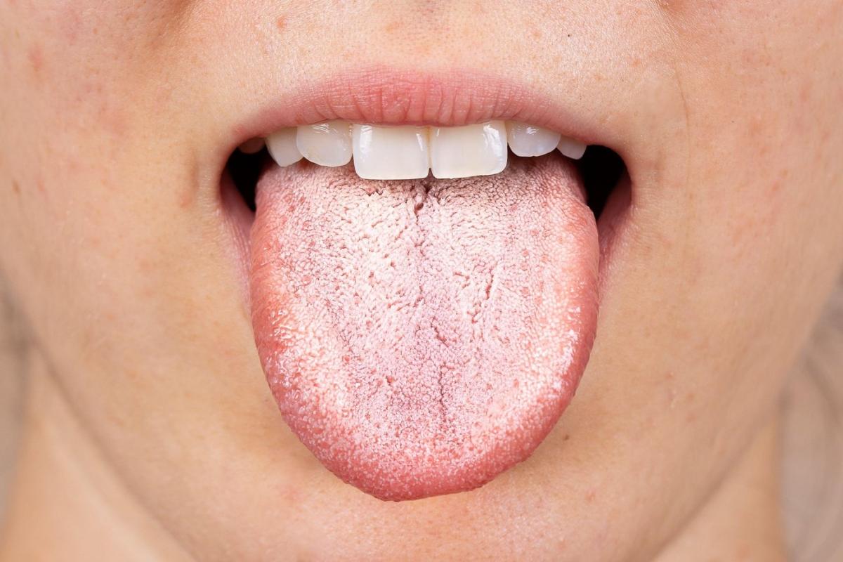 دلایل برفک دهان چیست؟ علائم و راه ‌حل درمان