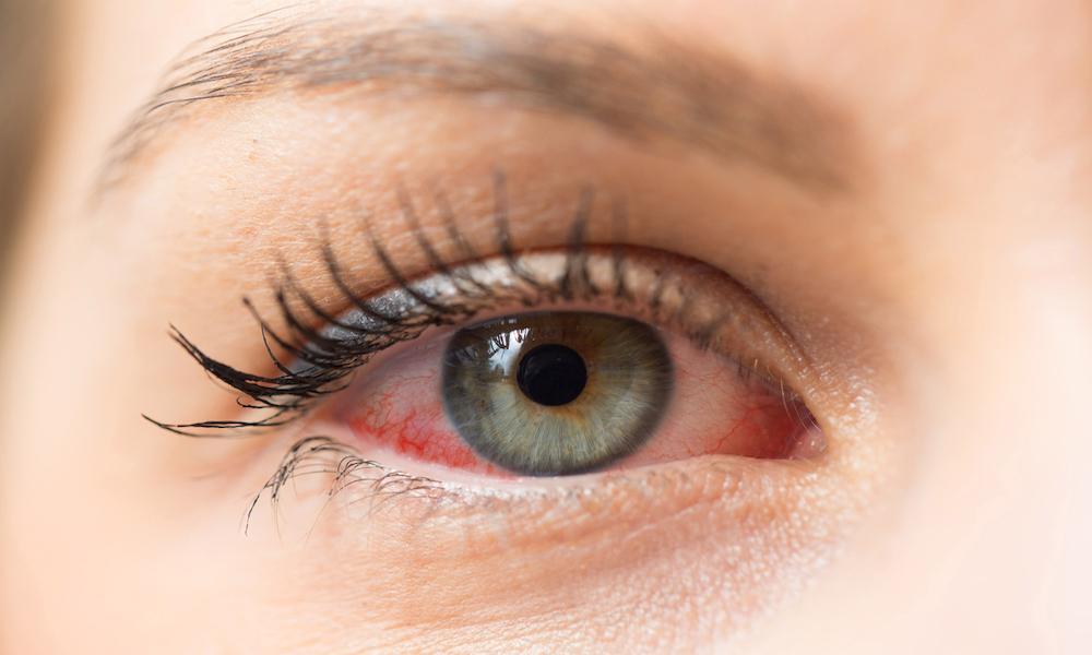 علت خشکی چشم چیست ؟علائم و راه حل درمان