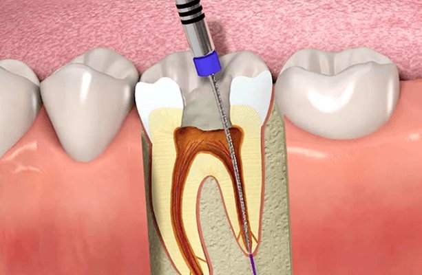 جراحی کانال ریشه دندان هر آنچه که باید بدانید