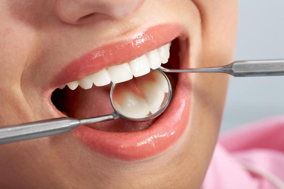 پوسیدگی دندان : علت آن چیست و چگونه می توان آن را درمان کرد؟