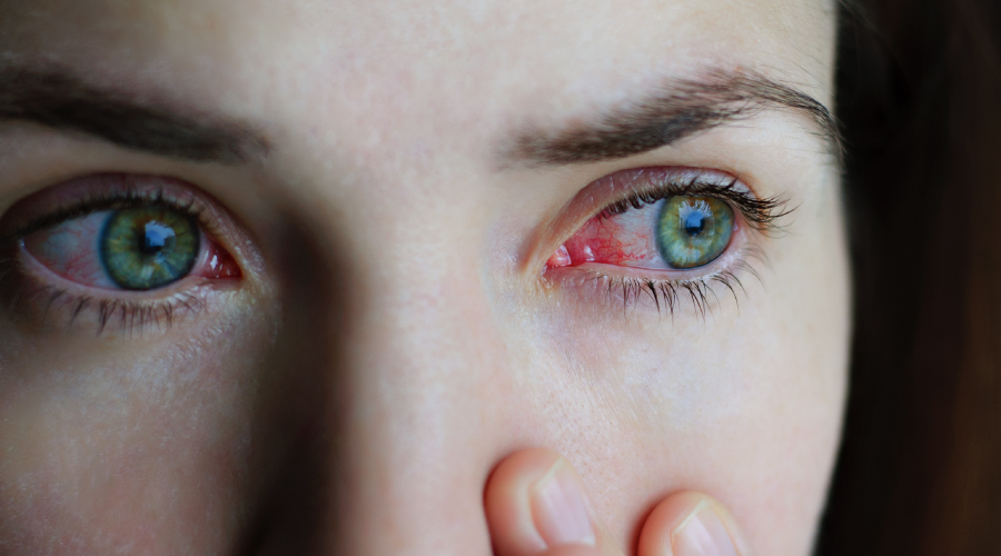 ورم ملتحمه چشم به عنوان نشانه ای از عفونت COVID-19