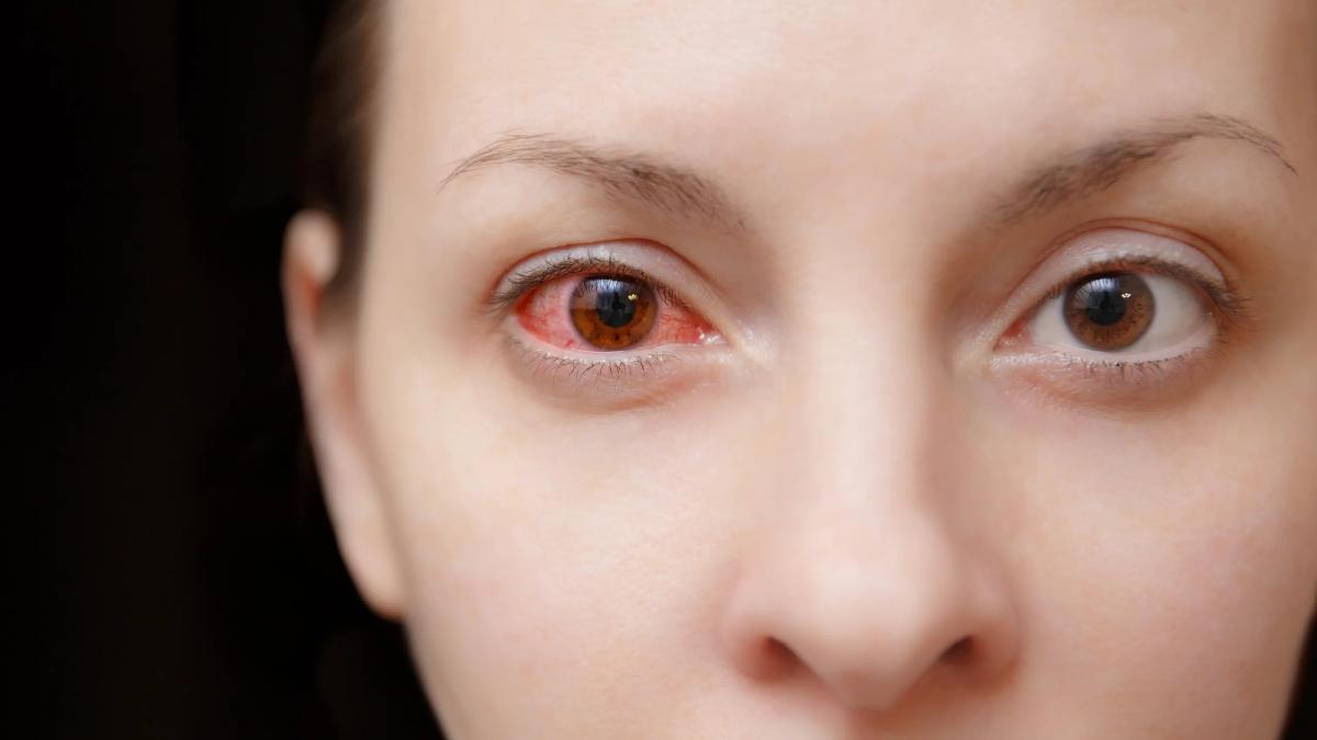 ورم ملتحمه چشم به عنوان نشانه ای از عفونت COVID-19