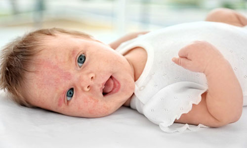 آلرژی غذایی در نوزادان و کودکان 