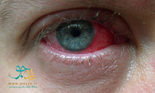  بیماری های چشم : کنژنکتیویت