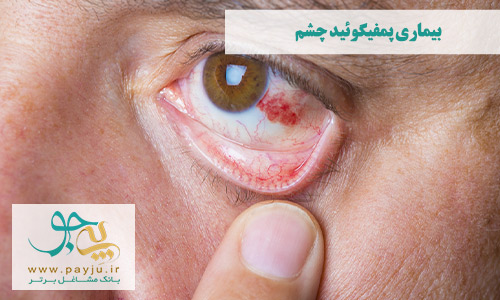 بیماری پمفیگوئید چشم و زخم شدن غشای چشم