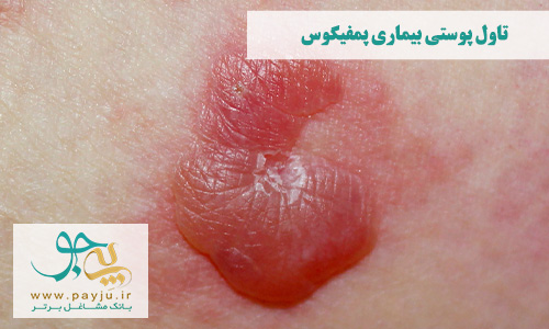 بیماری پمفیگوس با علائمی مانند تاول پوستی آبدار پر از مایع