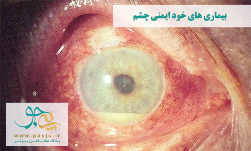 بیماری بهجت و زخم ملتحمه چشم که خطرناک و کور کننده است
