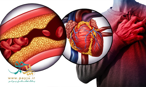کلسترول بالا گرفتگی عروق و بروز علائم سکته قلبی در مردان