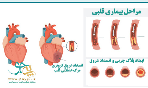 علت و مراحل سکته قلبی در مردان و زنان بیماری قلبی