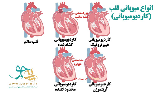 انواع بیماری عضلات قلب (کاردیومیوپاتی) مانند گشادی قلب