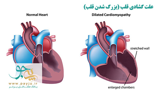 شایع ترین علت گشادی قلب - بیماری عضلات قلب