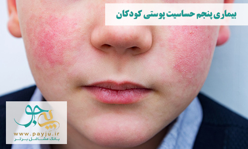 عکس واقعی لکه و بثورات بیماری پنجم حساسیت پوستی کودکان