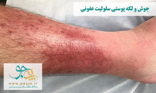عکس واقعی جوش و لکه پوستی بیماری سلولیت عفونی شبیه به سوختگی