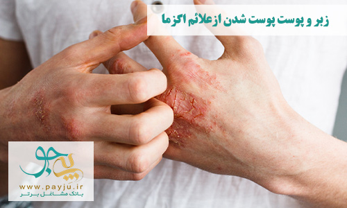 عکس واقعی خشکی و التهاب حساسیت پوستی دست در اگزما