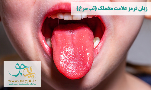 عکس زبان قرمز به علت مخملک بیماری پوستی کودکان