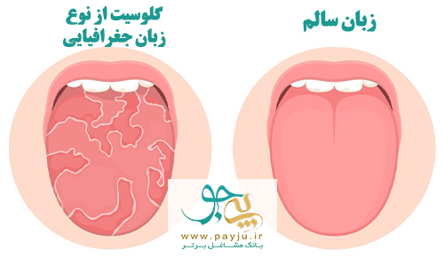 گلوسیت یا التهاب زبان چیست و چه علائمی دارد؟