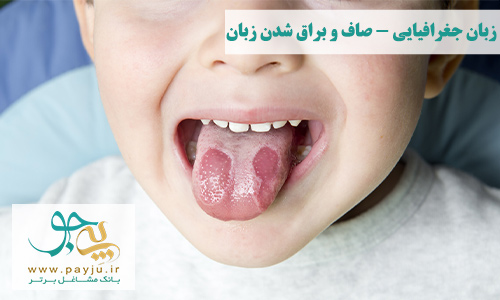 علائم گلوسیت صاف و براق شدن یا التهاب زبان