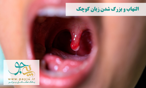 التهاب زبان کوچک یا ملاز