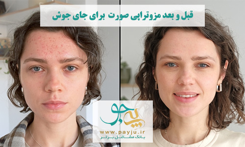 عکس قبل و بعد مزوتراپی صورت برای درمان جای جوش