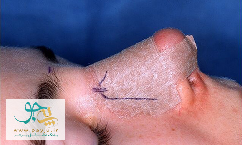 استفاده از اسپلینت یا گچ بینی بعد از عمل بینی