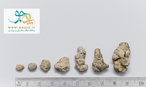 انواع بزرگ و کوچک سنگ کلیه Kidney Stones