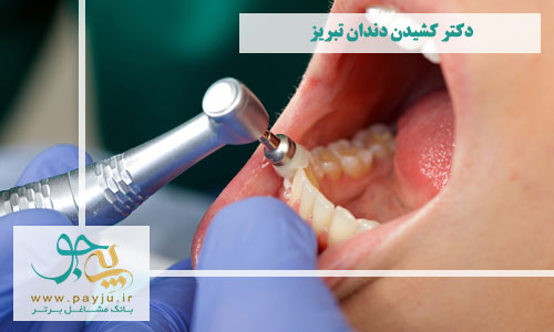 دکتر کشیدن دندان تبریز
