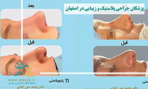 پزشکان جراحی پلاستیک و زیبایی در اصفهان - نتیجه عمل بینی قبل و بعد از آن
