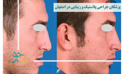 پزشکان جراحی پلاستیک و زیبایی در اصفهان - عمل بینی آقایان