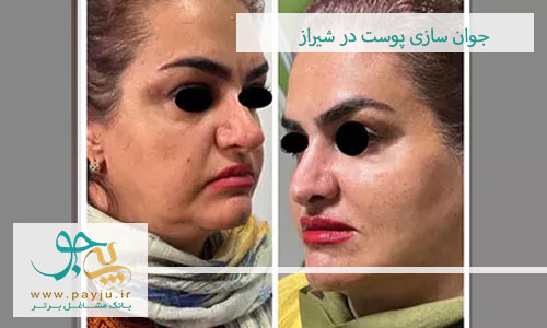 بهترین مرکز جوانسازی پوست در شیراز